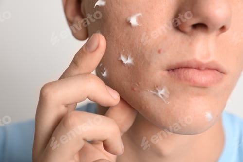 Preview: Teen guy with acne problem applying cream on light background, closeup