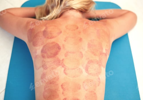 Preview: young woman with traces of vacuum cupping massage on her back