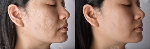 Preview: Skin problems and acne scar, Before and after acne facial care treatment, Beauty concept.