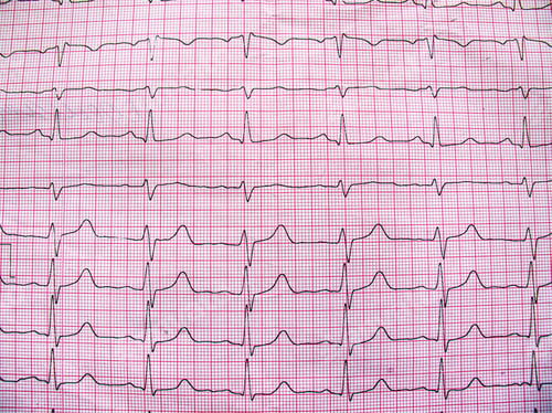 Preview: Electrocardiogram example of a normal 12-lead sinus rhythm, clos