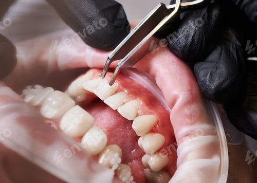 Preview: Dentist attaching orthodontic brackets to patient teeth.