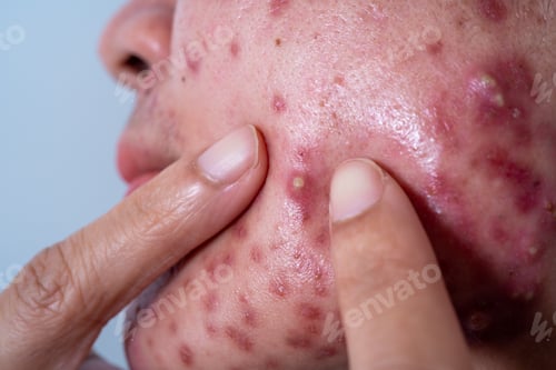 Preview: Acne on face because the disorders of sebaceous glands productions. Acne or a Cosmetic