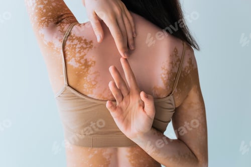 Preview: back view of brunette woman with vitiligo touching fingers behind back isolated on grey