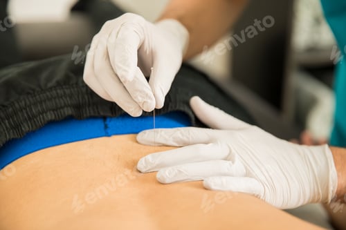 Preview: Physiotherapist Doing Dry Puncture On Back Of Male Patient