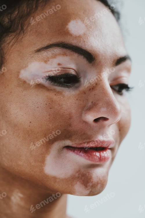 Preview: Beautiful woman with vitiligo skin