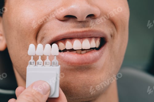 Preview: Dentist sampling shades teeth ,he holding teeth shades palette near male mouth. Whitening teeth
