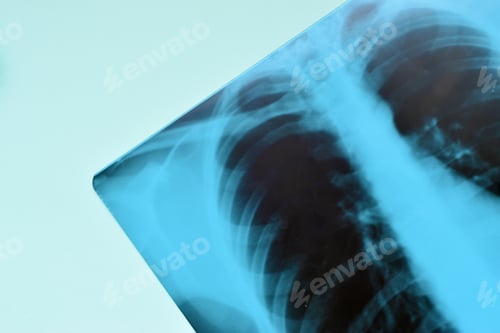 Preview: X-Ray film image of human chest for a medical diagnosis on blue hospital table. Flat lay top view