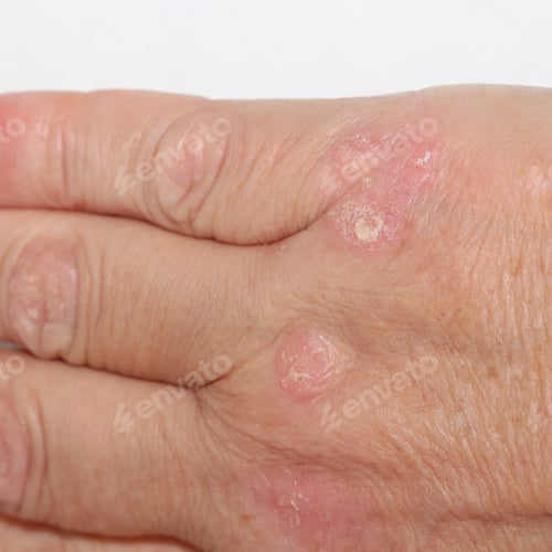 Preview: Plaque Psoriasis On Hand - Close Up Photograph Of The Back Of A Hand With Psoriasis On It.