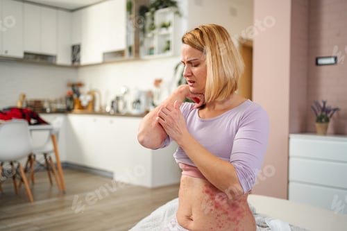 Preview: Woman scratching itchy red skin rash at home