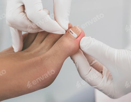 Preview: Doctor podiatry treats ingrown nail. onychocryptosis, nail disease