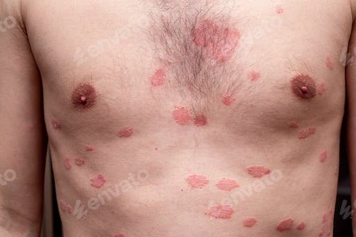 Preview: Psoriasis Vulgaris, skin patches are typically red, itchy, and scaly.