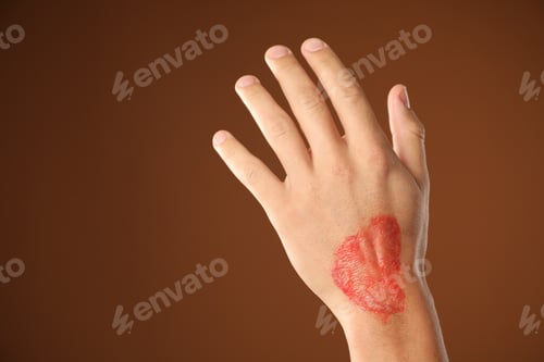 Preview: Man with burned hand on brown background, closeup. Space for text