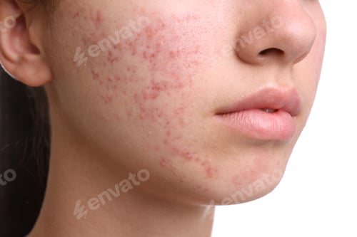 Preview: Teenage girl with acne problem on white background, closeup