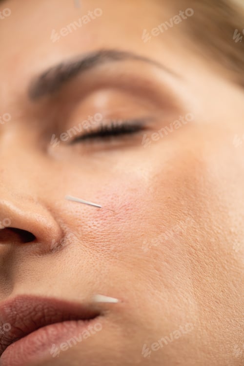 Preview: Acupuncture therapist stimulating acupoints on female patient face