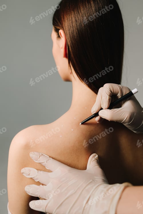 Preview: Migraine treatment procedure. Expert applies skin markings to relieve patient headache pain