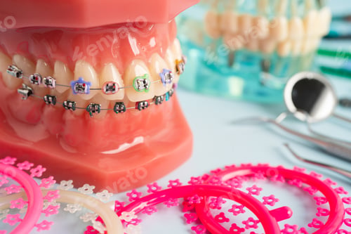 Preview: Orthodontic ligatures rings and ties, elastic rubber bands on orthodontic braces