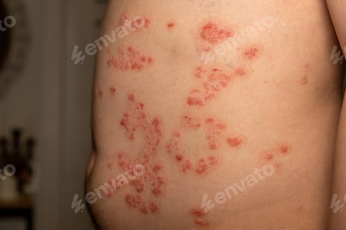 Preview: Skin patches exhibiting characteristics of psoriasis on the abdomen of an adult under natural