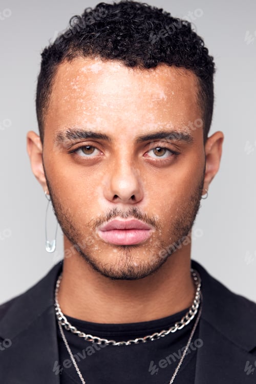 Preview: Studio Portrait Of Young Man With Skin Pigmentation Disorder Looking At Camera