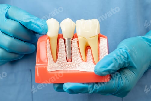 Preview: Asian dentist holding dental implant, artificial tooth roots into jaw