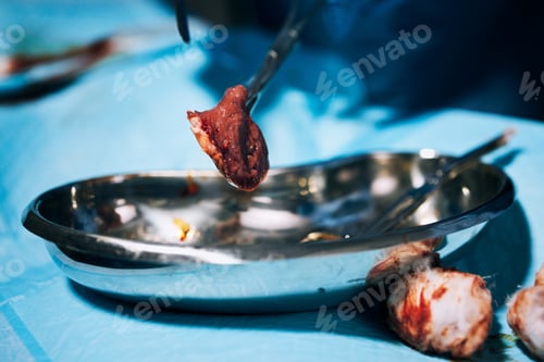 Preview: Metal tools, dish and medical surgery with blood, cotton and removal of cancer tumour in hospital.