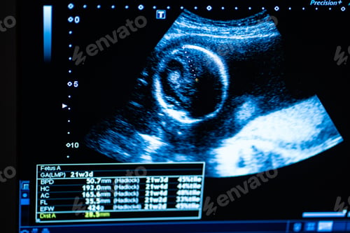 Preview: Monitor during ultrasound examination. Pregnancy.