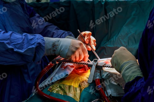 Preview: A surgeon performs coronary artery bypass grafting open heart surgery.