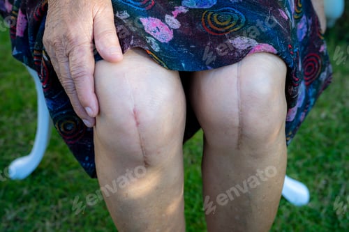 Preview: Asian senior lady old woman patient show her scars surgical total knee joint replacement.