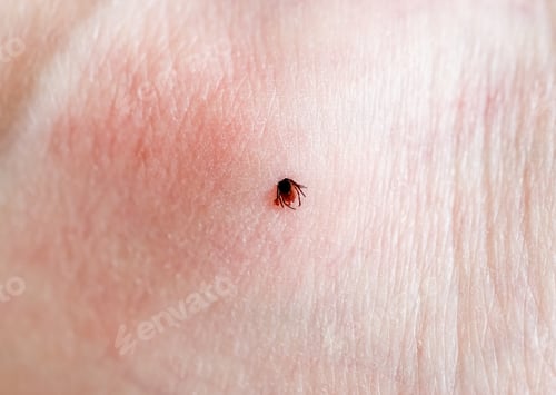 Preview: A tick embedded in a person skin.