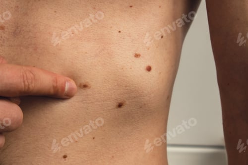 Preview: Unrecognizable man showing his birthmarks on skin Close up detail of the bare skin Sun Exposure