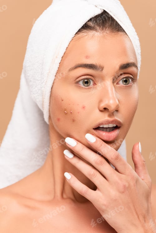 Preview: shocked and nude girl in towel touching face with acne isolated on beige