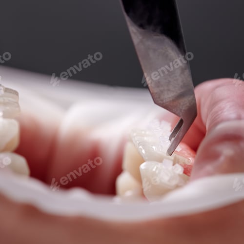 Preview: Dental specialist attaching white braces to patient teeth.