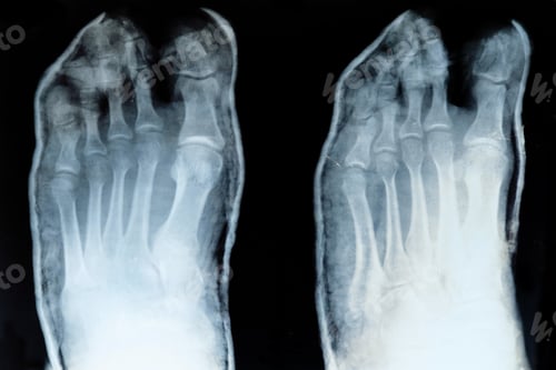 Preview: x-ray of toes, with displaced little finger