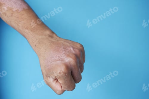 Preview: burns on man hand on blue background .