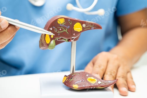 Preview: Cirrhosis, Liver cancer, fatty liver, Asian doctor with liver human anatomy