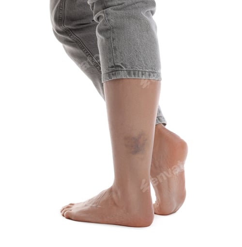 Preview: Woman with bruise on leg against white background, closeup