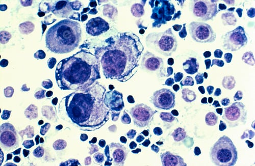 Preview: Metastatic breast cancer in pleural fluid