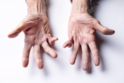 Preview: Man’s hands with Dupuytren contracture disease