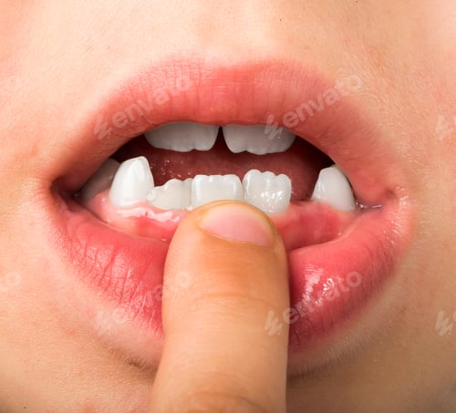 Preview: Child shows missing teeth.