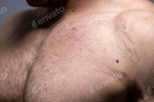 Preview: stretch marks on the arm