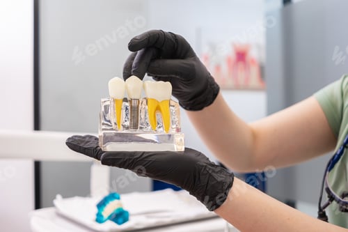 Preview: human teeth model, pointing crown of dental implant, offering advice on dental implant maintenance