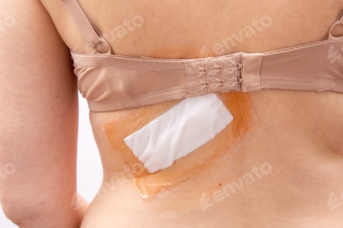 Preview: Adhesive bandage and surgical dressing after back surgery on a woman.