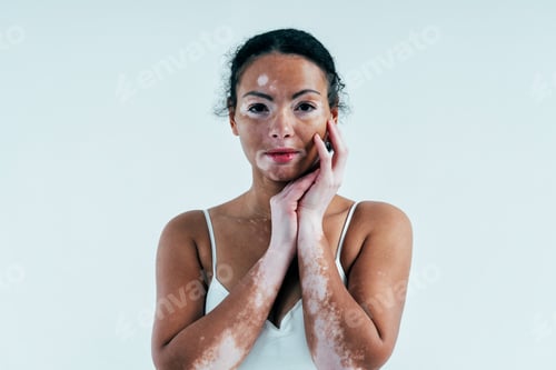 Preview: Beautiful woman with vitiligo skin