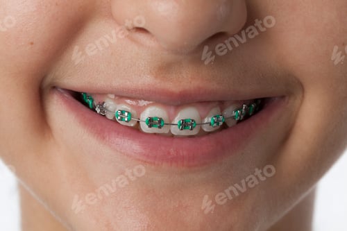 Preview: Close up of dental braces in the mouth of a teenage girl