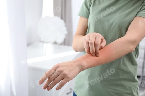 Preview: Woman with allergy symptoms scratching forearm indoors, closeup. Space for text