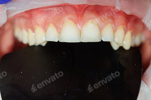 Preview: Close-up of teeth, dental checkup in the dental office. The dentist examines the patient's teeth