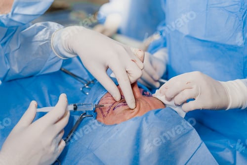 Preview: Thigh injection anesthesia before blepharoplasty & lipofilling in surgical clinic