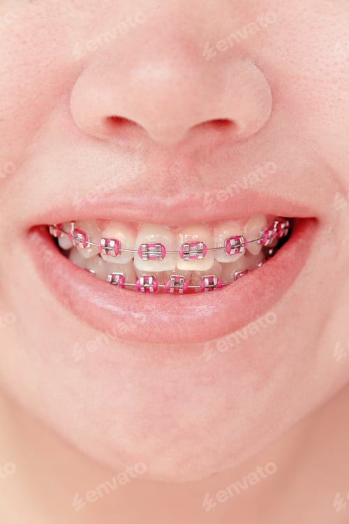 Preview: girl smiling with braces on teeth