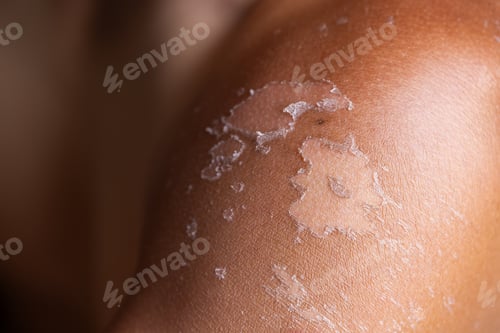 Preview: Man suffer from sunburned skin close up