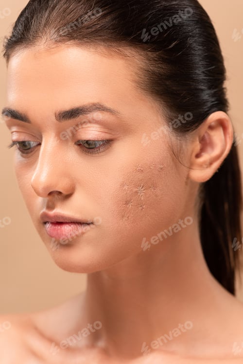 Preview: young naked woman with blemished skin isolated on beige
