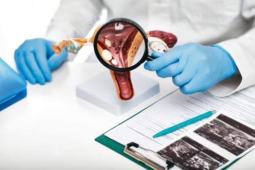 Preview: Close-up anatomical model of the uterus with pathologies. Gynecologist showing the polyps of the